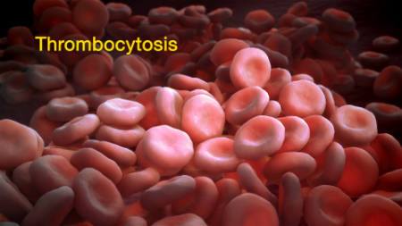 ترومبوسیتوز چیست و چه علائمی دارد؟